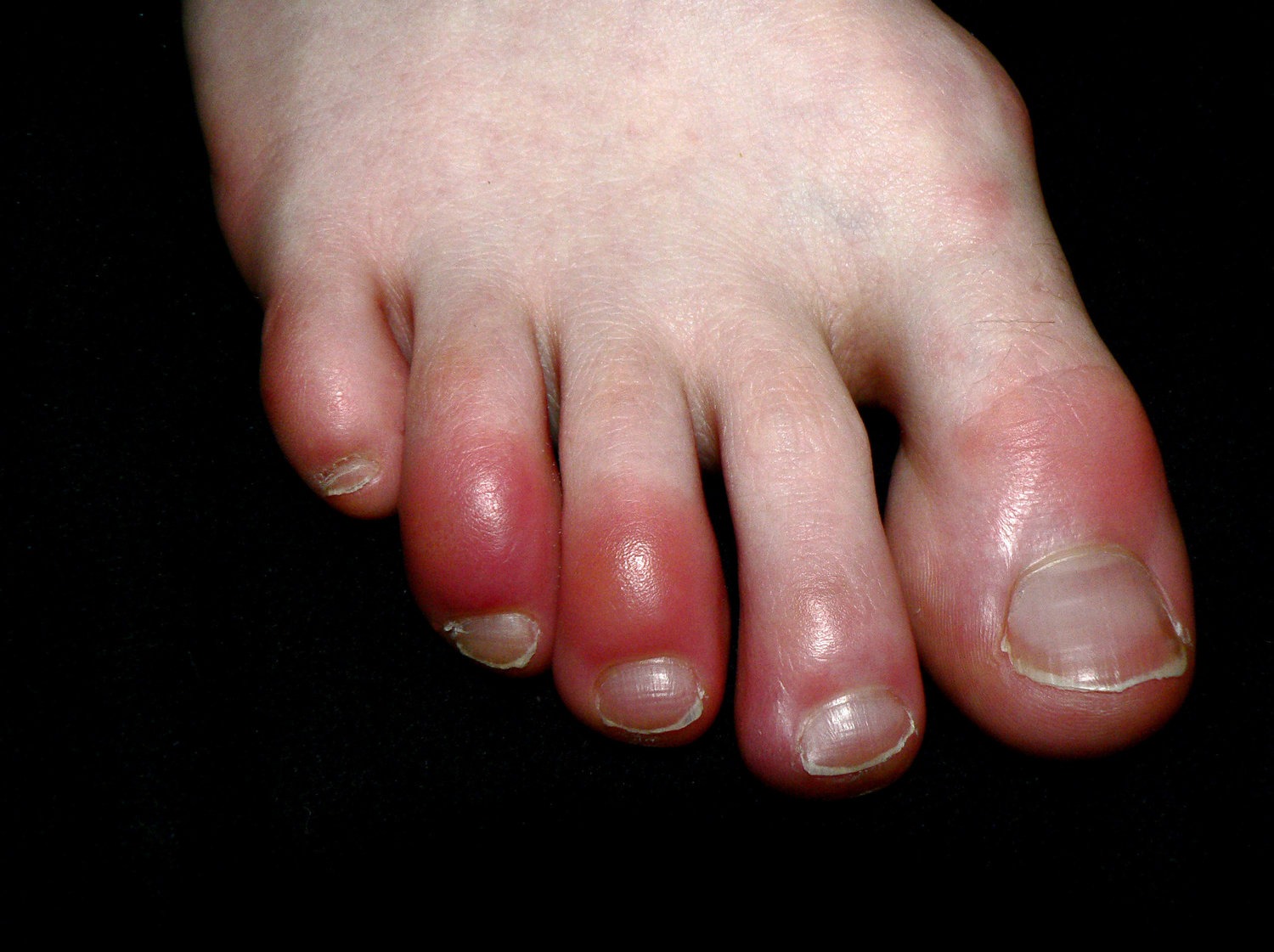 Chilblains (pictured) are itchy, red, pink or purple inflammations of the s...